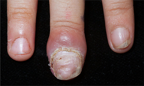 Figure 4 Chronic nail bed inflammation in a 6-year-old child with LOC Syndrome.