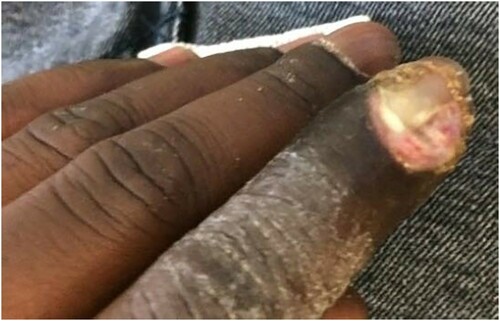 Figure 1. Cutaneous diphtheria in the form of a paronychia appearing after a travel to Mali.