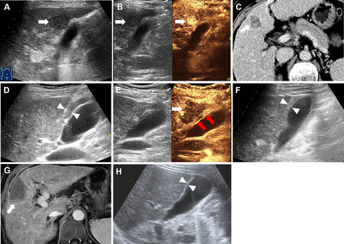 Figure 1 RFA of a 68-year-old female with HCC abutting the gallbladder under intra-operative contrast-enhanced ultrasound (CEUS) monitoring. (A–C). Conventional ultrasound, CEUS and contrast-enhanced CT image showed HCC nodule in segment V abutting to the gallbladder with a maximum diameter of 22 mm (white arrow). Before ablation, the thickness of the gallbladder wall was 4 mm. (D) The electrode was inserted parallel to the gallbladder wall with a minimum distance of 6 mm (white triangle). (E) CEUS showed that the perfusion of the gallbladder wall was intact (red arrow) and the index tumor had been completely ablated (white arrow). (F) The thickness of the gallbladder wall increased to 10 mm one day after ablation (white triangle). (G) One month later, the contrast-enhanced MR confirmed the result of complete ablation (white arrow). (H) The thickness of the gallbladder wall was restored to 4 mm after 4 months on conventional ultrasound image (white triangle).