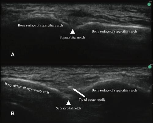 Figure 1 Ultrasound-guided supraorbital nerve puncture procedure.Notes: (A) An ultrasound image of the supraorbital notch (white triangle). The high frequency linear transducer was moved from the forehead caudally to locate the supraorbital notch (white triangle), which is a small groove on the bony surface; (B) ultrasonography imaging showing that the tip of the radiofrequency treatment trocar needle (white arrow) has reached the supraorbital notch (white triangle) via the out-of-plane approach.