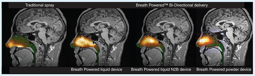 Figure 6. Initial gamma deposition in the same subject.Initial gamma deposition (0–2 min after delivery) in the same healthy subject following self-administration with a traditional spray and three Breath Powered™ device variants, the standard and the nose to brain variants of the multidose liquid device and the powder device shown in Figure 4.N2B: Nose to brain.Reproduced with permission from [Citation23,Citation48,Citation132].