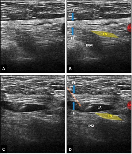 Fig. 2 Ultrasound guided demonstration of the fascia iliaca compartment block: A and B: ultrasonographic anatomy of the fascia iliaca compartment: FI (Fascia iliaca), FL (Fascia lata), FN (Femoral nerve), IPM (Iliopsoas muscle), FA (Femoral artery). C and D: ACB: needle location indicated by an arrow with local anesthetic (LA) deposited below the fascia iliaca.