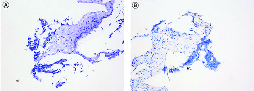 Figure 3. Staining images of PD-L1 expression (HE and IHC).(A) HE staining images of PD-L1 expression. (B) IHC staining images of PD-L1 expression.HE: Hematoxylin-eosin staining; IHC: Immunohistochemistry.