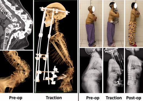 Figure 2. Case 2: CT revealed angular kyphosis in the lumbar region, almost complete absence of the vertebral bodies of L2 to L4, and complete fusion of the laminas of L1 to L5. Management consisted of HPT and anterior instrumentation and posterior fusion.