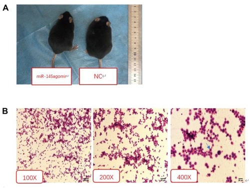 Figure 1 Indicators of model success. (A) Compared with the NC group, the miR-145agomir group had less abdominal distension. (B) H&E staining showed large nuclear staining, lymphoblastic liver cancer H22 cells.Abbreviations: NC, negative control; H&E, hematoxylin & eosin.