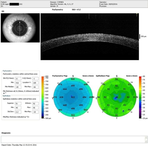 Figure 6 Post-op right eye (4 months) showing normalized postoperative stromal and epithelial thicknesses.