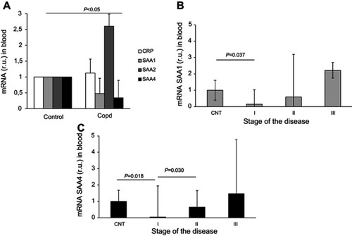 Figure 3 Gene expression of acute phase reactants in resistant smokers (controls) and COPD patients in blood cells (A). SAA1 (Panel B) and SAA4 (Panel C) expression in blood cells according to COPD stage. I, GOLD I COPD; II, GOLD II COPD; III, GOLD III COPD. No statistically significant differences were identified (P>0.05).