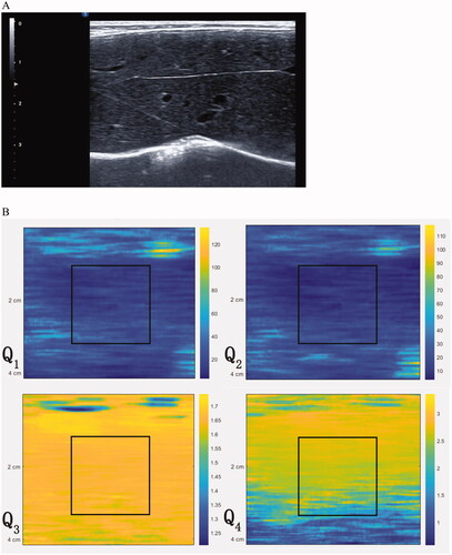 Figure 1. (A) B-mode ultrasound images while recording echo signals. (B) Acoustic nonlinearity map was composed of 4 channels derived from 4 imaging functions (Q1, Q2, Q3 and Q4) with a total of 740 * 110 * 4 pixels. The region of interest (ROI) with size of 2 cm * 2 cm was positioned 1 cm below the liver capsule in each acoustic nonlinearity map.