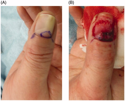 Figure 2. Surgical findings. (A) A reddish mass is seen under the nail plate. The excision line after the nail claw is indicated in blue. (B) After excision, skin grafting was performed from the thenar eminence.