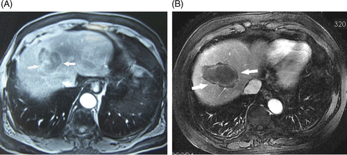 Figure 2. Transverse contrast-enhanced T1-weighted MR images in a 74-year-old man who underwent microwave ablation of HCC. (A) Hepatic arterial phase pre-ablation image shows a 5.9 × 4.2 cm HCC (arrow). (B) Hepatic arterial phase image post-ablation 6 months shows a 7.1 × 5.1 cm non-enhancing zone of hypointensity enveloping the tumour (arrow).