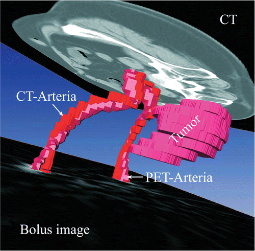 Figure 1. 3D image after fusion with the relevant structures: CT and PET are fused in three dimensions using the surfaces of the labeled common iliac artery segment in both the CT and PET bolus images. The segmented CT common iliac artery surface is plotted in red and the PET surface in pink. The cross-section of the common iliac artery PET-label used for fusion was typically only in the range of 2-3 PET voxels. Additionally, the tumor was segmented in the CT images and the tumor VOI transferred to the PET images. The tumor surface is plotted in pink. Also, the original CT scan and a bolus PET image used for labeling are both plotted with a representative slice in their 3D fused image position.