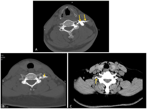 Figure 2 Cervical nerve root block on CT scan images: The yellow arrow points to the needle in front of the posterior tubercle.((A) C4; (B) C5; (C) C6).