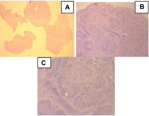 Figure 5 (A) Lesion consisting of mature, lobulated cartilage tissue of varying sizes (H&e, 10×). (B) Chondrocytes forming lobular structures within well-defined chondroid matrix (H&e, 40×). (C) Chondrocytes displaying polygonal nuclei with clear cytoplasm.