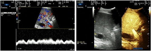 Figure 1 Left: color Doppler ultrasound image. The hepatic artery blood flow signals disappeared and only the portal vein blood flow signals were displayed. Right: contrast-enhanced ultrasound image. The contrast arrived at the hepatic artery and portal vein at the same time, the hepatic artery was visualized and had small diameter and the peak intensity of the contrast was significantly lower than that of portal vein (arrow).