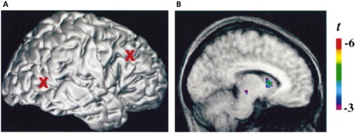 Figure 5. (A) Electrical stimulation of the cortex. (B) Induced dopamine release in the caudate nucleus due to stimulation of the cortex. Source: Strafella et al. (Citation2001).