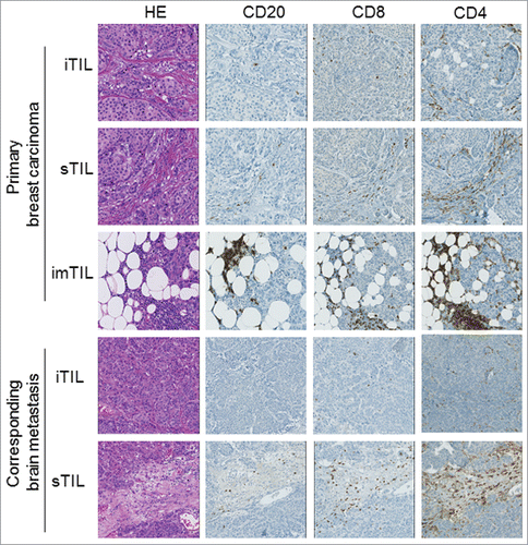 Figure 1. Distribution pattern of TIL subsets in the three tumor compartment of a representative primary breast cancer and its corresponding brain metastasis. Illustration of a primary breast carcinoma and its corresponding brain metastasis with HE as well as CD4+, CD8+ and CD20 immunostainings in all three examined tumor compartments are depicted (iTIL: intratumoral infiltrating lymphocytes, sTIL: stromal infiltrating lymphocytes, imTIL: infiltrative margin infiltrating lymphocytes).