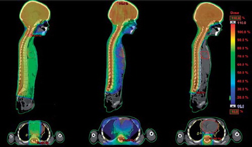 Figure 1. Dose distributions in the sagittal and transversal plane related to treatment with (from left) 3D CRT, RapidAarc and IMPT.