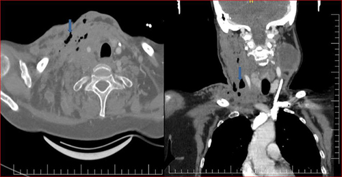 Figure 2 Coronal and axial neck CT scan reveals inflamed soft tissue with loculated gas in the right side of the neck and supraclavicular region (necrotising fasciitis of the neck).