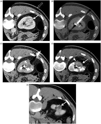 Figure 1. Low-dose CT protocols for guiding RFA in a 34-year-old man. (A) Contrast-enhanced axial CT image in the planning phase shows the location, size and number of RCC (white solid arrow) before lesion targeting. A white blank arrow indicates a grid for localising a tumour. (B) Unenhanced axial CT image in the targeting phase shows the direction and location of an electrode (black arrow) that is placed within the tumour. (C) Unenhanced axial CT image for monitoring phase shows the ablation area (arrowheads). No complication occurred following each ablation cycle. A black arrow indicates an electrode. (D) Unenhanced axial CT image for survey phase shows that the tumour size (white solid arrow) and tumour margin (arrowheads) are markedly shrunken. Overall CT image quality shown in (A–D) is not good but acceptable for RFA procedures. (E) Contrast-enhanced axial CT image, which is obtained 51 months after RFA, shows no local tumour progression but a post-ablation scar tissue (white solid arrow).