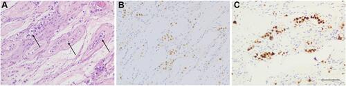 Figure 2 Immunohistochemical staining in GCNIS. GCNIS features large atypical tumor cells located (arrow) on the periphery of seminiferous tubules with prominent nucleoli and abundant clear cytoplasm (A). The tumor cells were strongly positive for TdT (B). These GCNIS cells are confirmed by OCT4 (C) (amplification: 10×20, bar=50μm).