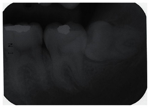 Figure 3 Left mandibular third molar of a 19-year-old woman with acute pericoronitis.