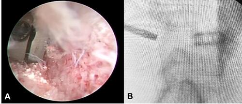 Figure 5 (A) Cage insertion under endoscopic view. (B) Confirmation on image intensifier.