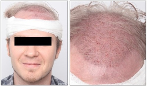 Figure 1 Representative photographs of the operating field of a male patient (28 years) directly after hair transplant surgery at the Moser Medical, Clinics for Aesthetic and Plastic Surgery in Vienna.