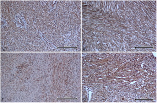 Figure 3. Merlin staining images in uterine smooth muscle tumour types of some patients. A. Leiomyoma showed moderate immunoreactivity with Merlin (immunoperoxidase, 200×). B. Mitotically active leiomyoma showed moderate immunoreactivity with Merlin (immunoperoxidase, 200×). C. STUMP showed moderate immunoreactivity with Merlin (immunoperoxidase, 200×). D. LMS showed strong immunoreactivity with Merlin (immunoperoxidase, 200×). Scale bar = 500 µm.
