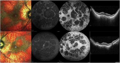 Figure 2 Multimodal imaging from an affected CHM male patient. Multicolor images (left) show areas of RPE atrophy in the macula. Blue fundus autofluorescence (middle left) and fluorescein angiography (middle right) images display the presence of RPE and choroidal atrophy, respectively. Structural OCT images (right) demonstrate a thin choroid and an RPE and outer retinal atrophy. Images of this patient courtesy of Prof. Eric Souied, MD, PhD.