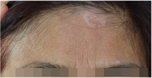 Figure 1 Before treatment, approximately 2.5cm × 1.5 cm white patches on the patient’s forehead.