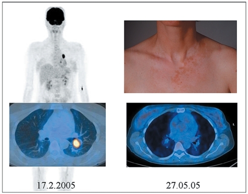 Figure 2 Complete remission associated with vitiligo-like depigmentation after therapy with dacarbazine and PegIFN-α.