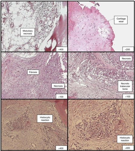 Figure 1 Panel showing frequent changes in histological sections of femoral bone tissue of patients living with HIV and undergoing THA.