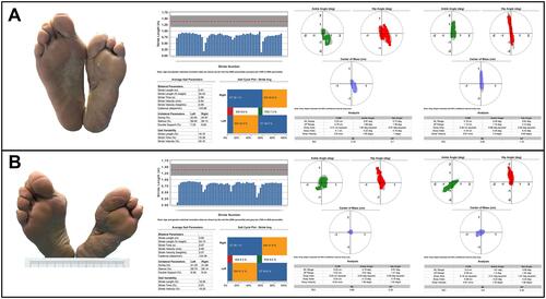 Figure 4 Biomechanical parameter improvement following treatment with offloading therapeutic footwear. (A) Biomechanical parameters including ankle angle, hip angle, center of mass, gait, and balance before wearing the custom-made footwear; (B) Changes in biomechanical parameters after wearing the custom-made footwear.