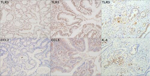 Figure 6 Immunohistochemistry for CCL2, CCL5 and IL-8 in TLR3-positive CRC in surgical specimens. In TLR3-positive CRC specimens, CCL2 was partially stained in the cytoplasm of tumor cells (arrow head). CCL5 was uniformly stained in the cytoplasm of the tumor cells and was also found in the surrounding stromal cells. IL-8 was uniformly and faintly stained in the cytoplasm of tumor cells and also stained in stromal cells (Magnification: 200×).