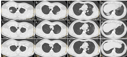Figure 1 Chest computed tomography (CT) images of the patient. Chest CT on admission showing bilateral pneumonia (A–D). Chest CT after 2 weeks of treatment showing improvement in the bilateral pneumonia (E–H); Chest CT after 4 weeks of treatment showing complete resolution of the lung changes (I–L).