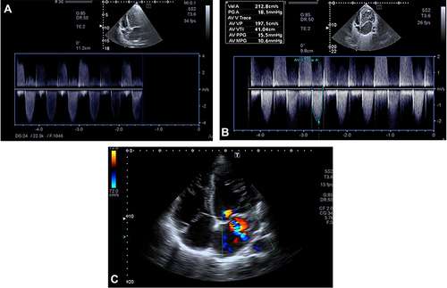 Figure 3 (A–C) Echocardiographic findings: five-chamber view of two-dimensional echocardiography obtained at the time of presentation revealed noncompaction layers of left ventricular with subaortic membranous senosis and four chamber view with Doppler.