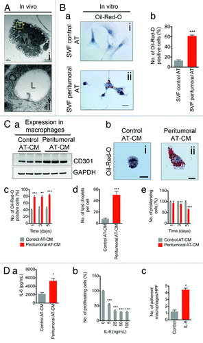 Figure 3. Peritumoral adipose tissue is enriched with lipid-laden inflammatory cells in vivo and macrophages can be induced to differentiate in response to peritumoral adipose tissue conditioned medium in vitro. Electron micrograph demonstrating the presence of lipid-laden macrophages within peritumoral AT (A). The boxed yellow area is magnified in (ii). Increased numbers of lipid-laden cells within the SVF from peritumoral AT (B, a and b). Western blotting revealed increased CD301 expression in monocytes incubated with peritumoral AT-conditioned medium when compared with control AT-conditioned medium (C, a). Change of cell morphology and increased lipid droplet number in cells incubated with peritumoral AT-conditioned medium (b–d). Monocyte proliferation is decreased in the presence of peritumoral AT-conditioned medium compared with control AT conditioned medium (e). IL-6 secretion in control and peritumoral AT-conditioned medium measured by ELISA (D, a). Decreased number of proliferating monocytes and increased number of adherent macrophages upon stimulation with IL-6 (b and c). Data presented are mean values ± SEM *P < 0.05; **P < 0.01; and ***P < 0.001, the Student t test.