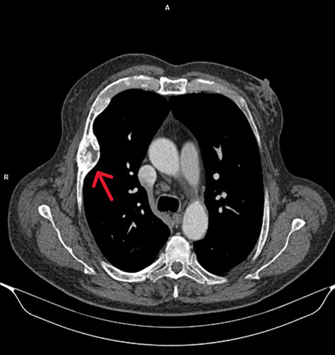 Figure 3 Thorax CT after i.v contrast, 18 months post treatment showed regression of the tumor in the thoracic cage (from 4.7×3.9 to 4.3×2.8 cm) and the ribs, as shown with the red arrow.