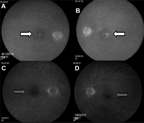 Figure 2 Fluorescein angiography 1 week following systemic injection of PGE1 of right (A) and left (B) eyes, and following treatment of right (C) and left (D) eyes.