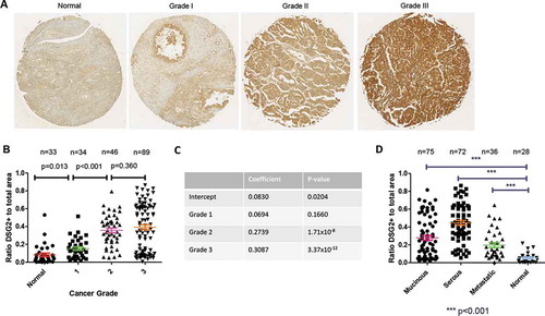Figure 2. DSG2 is differentially expressed in ovarian cancers by grade and pathologic classification (localization)