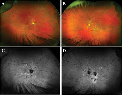 Figure 5. Multimodal imaging on initial presentation of Patient 2. A-B. Ultra wide-field fundus images showed multifocal extrafoveal RPE changes, exudates and nasal scarring in both eyes. C-D. Fundus autofluorescence images revealed stippled hypoautofluorescent areas with edges of hyperautofluorescence in macula and nasal to optic disc, scattered similar lesions along arcades in both eyes.