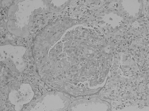 Figure 1. Glomerulus showing mesangial proliferation with cellular crescent formation (periodic acid–Schiff stain, ×400).