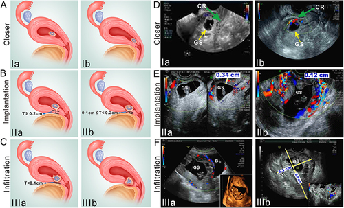 Figure 3 Diagrams of different CSP types and their corresponding Doppler ultrasound characteristics. CSP can be divided into three types: closer type (type I), implantation type (type II) and infiltration type (type III). (A) Closer type (type Ia and type Ib). (B) Implantation type: implantation IIa (thickness ≥ 0.2 cm) and implantation IIb (0.1 cm ≤ thickness < 0.2 cm). (C) Infiltration type: type IIIa (thickness < 0.1 cm) and type IIIb (mass type). (D–F) Ultrasound characteristics of CSP corresponding to different subtypes.