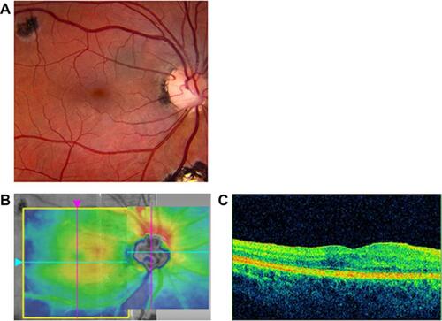 Figure 4 Final follow-up 3.4 years postoperatively. (A) Fundus image showing resolved maculoschisis and closed PMC (subtle optic disc pit is visible inferiorly). (B) Final OCT topographic image of the macula. (C) OCT horizontal section showing a dry, concave fovea with CMT of 322 microns (visual acuity 20/25) (04/02/2018, CMT 322 microns, Volume 10.2 mm3).Abbreviations: OCT, optical coherence tomography; CMT, central macular thickness; CMT, central macular thickness.