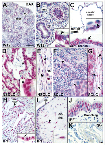 Figure 6. BAX localization in fetal and adult lung tissues by immunohistochemistry. (A and B) Immunohistochemistry showing BAX staining (red chromogen) in human fetal lung at 12 weeks of gestation. Note that BAX was nuclear in epithelium (ep) and in the mesenchyme (mes). Higher magnification is showed in (B) showing BAX nuclear staining in epithelial cells (black arrow). (C) BAX localization in normal alveolar (upper panel) and bronchiolar (arrow in lower panel) epithelia. The insert in the upper panel shows BAX staining in the normal alveolar epithelium (arrow). (D and E) BAX staining in (D) the epithelium of lung non-small cell lung carcinoma (NSCLC) such as adenocarcinoma (arrow); and (E) within the tumor stroma (arrows). (F and G) BAX staining in (F) the epithelium of small cell lung carcinoma (arrow, SCLC n = 8) and (G) within the tumor stroma (arrow). Note that the fibroblasts within the stroma of these tumors also displayed BAX nuclear staining (see arrows in E and G). (H-J) BAX staining in idiopathic pulmonary fibrosis (IPF), the insert in (H) shows BAX staining in the hyperplastic epithelium (hyp AE2C, arrow). (I) BAX staining within fibroblastic foci (Fibro foci) underneath remodeled distal epithelium (ep) in IPF lung. Note the nuclear BAX staining in the fibroblasts (arrow) within fibroblast foci (J) BAX staining within bronchiolised distal airspace (bronch ep) in IPF lung. (K) Negative staining with control IgG. Nuclei are counterstained with hematoxylin. BAX nuclear localization was also confirmed using another anti-BAX primary antibody in control and IPF lung tissues by immunohistochemistry (data not shown). Scale bar: 20 µm (B, G, E, I, J, and lower panel in C), 10 µm (inserts in B, C, D, F, G, and H), 100 µm (A), 80 µm (C, D, F, K, and H).