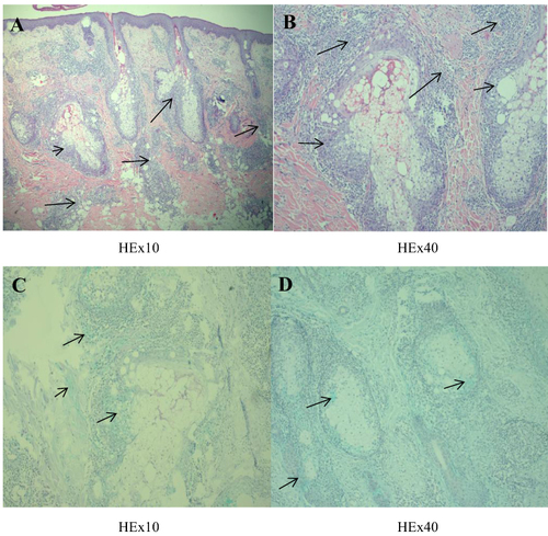 Figure 2 Histopathology: (A) Mild epidermal hyperplasia, lymphocytic and eosinophilic infiltration around the superficial middle dermal vessels and appendages (black arrow), (B) eosinophilic and neutrophilic abscesses seen in local hair follicles (black arrow). (C and D) Acidic mucin deposits around the hair follicle and the hair follicle’s sebaceous glands (black arrow).