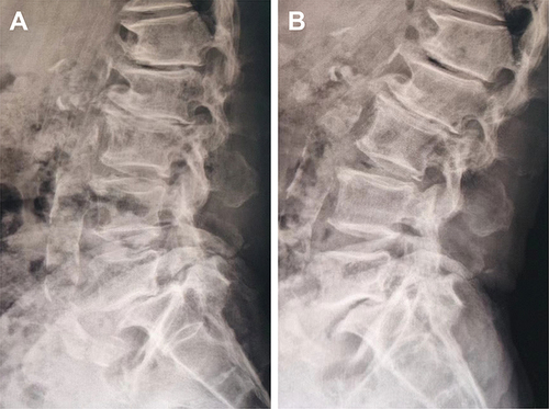 Figure 6 Postoperative flexion (A) and extension (B) lateral view showing degenerative lumbar isthmic spondylolisthesis and stability of L5-S1 (< 3 mm dynamic sagittal translation).