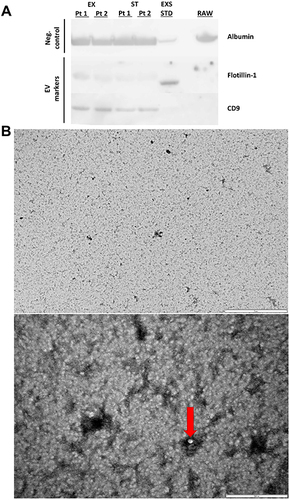 Figure 1 Plasma EV characterisation using the following methods: (A) Western blot of negative control marker Albumin and EV markers flotillin-1 and CD9 presence or absence in exacerbating COPD (EX) (n=2) and stable (ST) (n=2) patients (Pt), as well as lyophilised exosome standard from plasma (EXS STD) and raw plasma (RAW). (B) A representative widefield (left panel) and close-up (right panel) TEM images of plasma EVs isolated from a COPD patient during an exacerbation event. The red arrow indicates small EVs. Calibrated scale bars (5µm, left panel and 500nm, right panel) are included for reference.