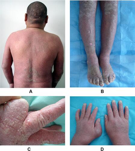 Figure 1 Erythroderma and thickened skin, with lichenification on some parts of the back (A). Swelling of the legs, lichenification on the knees and toes, and sunken scars on the right leg (B). Myxoid cyst, erythema, and scales were noted on the patient’s fingers (C). Swelling of metacarpophalangeal joint of left thumb with psoriatic involvement on each nail (D).
