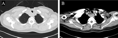 Figure 1 Contrast-enhanced chest CT of the patient on September 1, 2022. Space-occupying lesion of anterior upper mediastinum is shown. A low-density necrosis area can be seen on enhanced scan, which is separated from the surrounding esophagus. (A) Lung view. (B) Mediastinal view.
